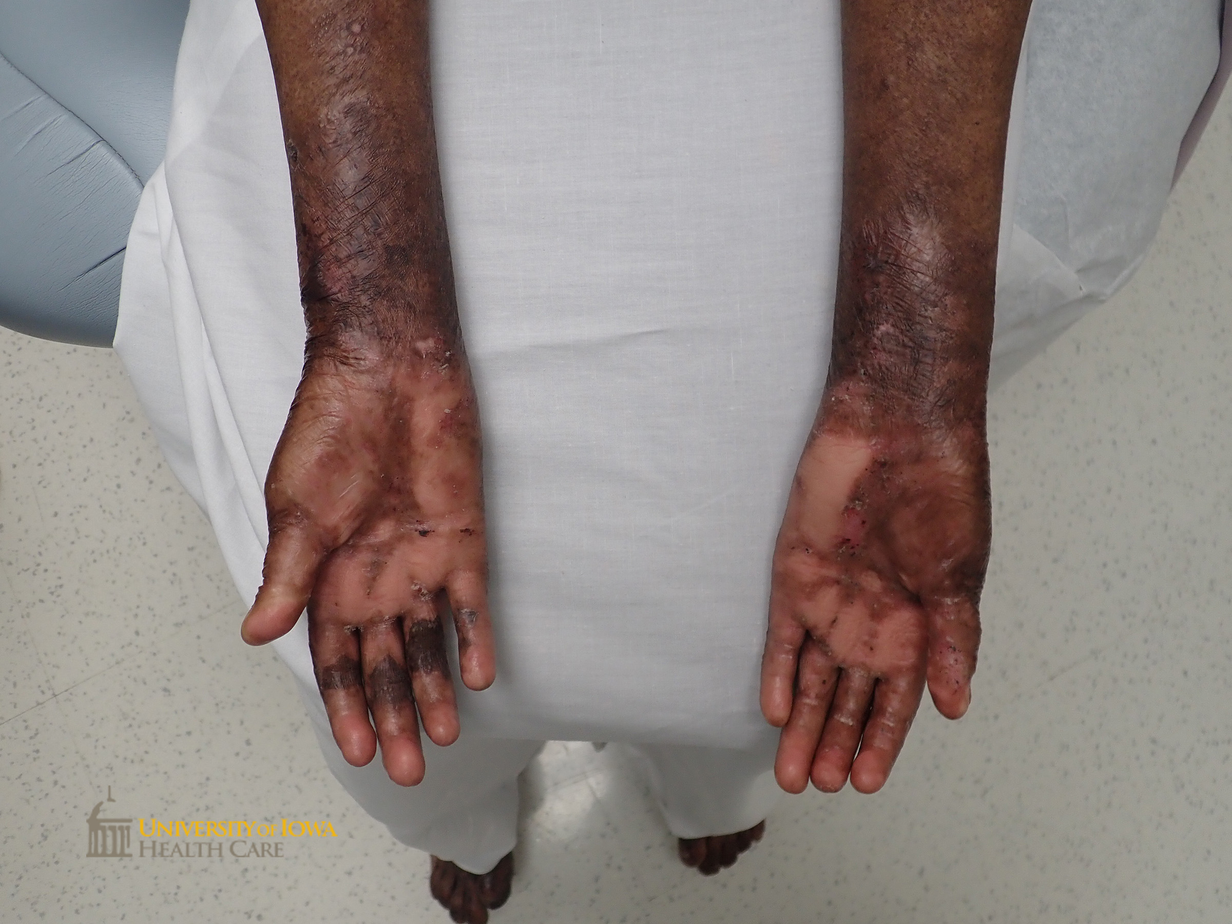 Pink scaring of bilateral palms with focal areas of erosion. (click images for higher resolution).